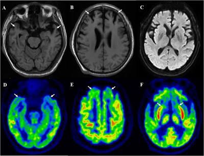 Alterations of Striatal Subregions in a Prion Protein Gene V180I Mutation Carrier Presented as Frontotemporal Dementia With Parkinsonism